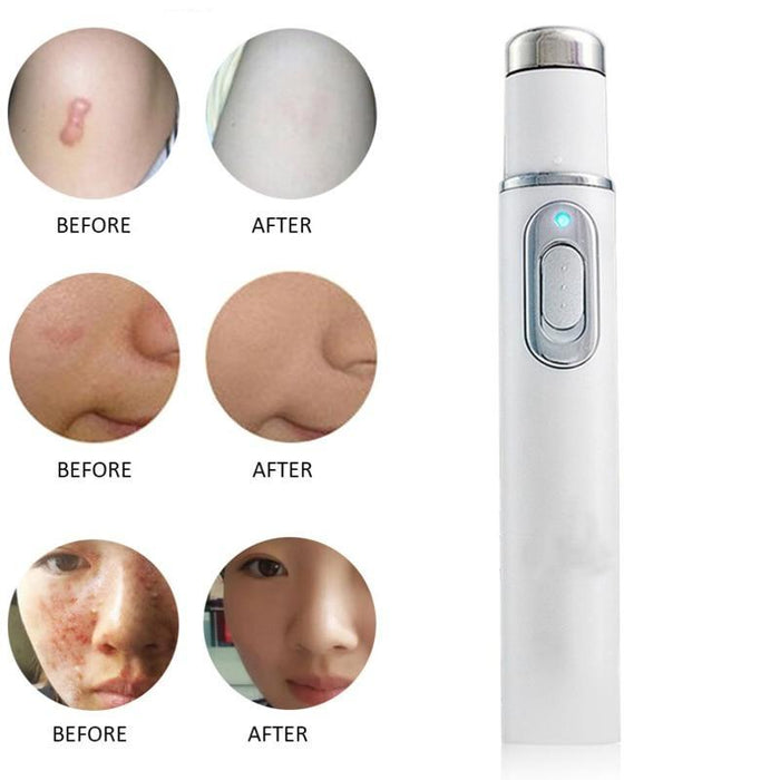 Medical Blue Light Therapy Laser Treatment Pen Acne Scar Wrinkle Removal Tools - Smart Living Box